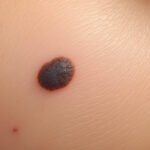 Comment reconnaître un grain de beauté en relief